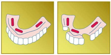 ПРОТЕФИКС PREMIUM крем фиксирующий Экстра-сильный 47г (40мл)